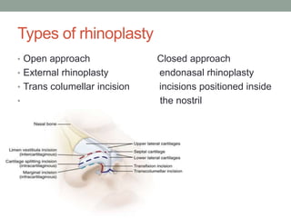 Types of rhinoplasty
• Open approach Closed approach
• External rhinoplasty endonasal rhinoplasty
• Trans columellar incision incisions positioned inside
• the nostril
 