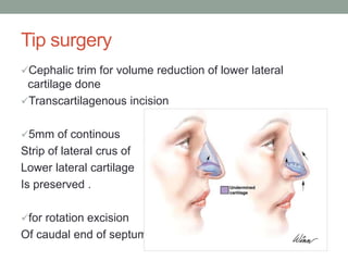 Tip surgery
Cephalic trim for volume reduction of lower lateral
cartilage done
Transcartilagenous incision
5mm of continous
Strip of lateral crus of
Lower lateral cartilage
Is preserved .
for rotation excision
Of caudal end of septum
 