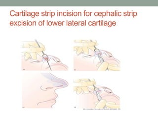 Cartilage strip incision for cephalic strip
excision of lower lateral cartilage
 