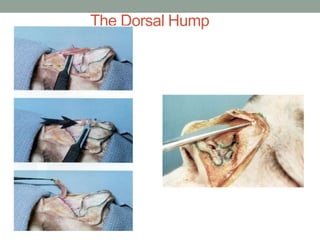 The Dorsal Hump
 
