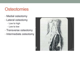 Osteotomies
• Medial osteotomy
• Lateral osteotomy
• Low to high
• Low to low
• Transverse osteotomy
• Intermediate osteotomy
 