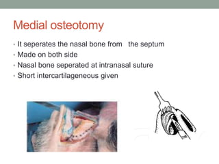 Medial osteotomy
• It seperates the nasal bone from the septum
• Made on both side
• Nasal bone seperated at intranasal suture
• Short intercartilageneous given
 