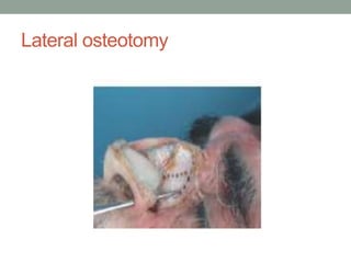 Lateral osteotomy
 