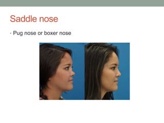 Saddle nose
• Pug nose or boxer nose
 