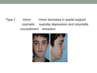 Type 1 minor minor decrease in septal support
cosmetic supratip depression and columella
concealment retraction
 