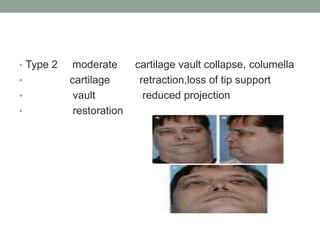 • Type 2 moderate cartilage vault collapse, columella
• cartilage retraction,loss of tip support
• vault reduced projection
• restoration
 