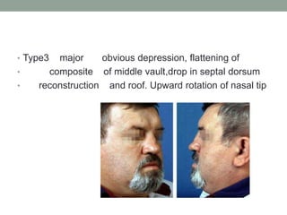 • Type3 major obvious depression, flattening of
• composite of middle vault,drop in septal dorsum
• reconstruction and roof. Upward rotation of nasal tip
 
