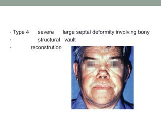 • Type 4 severe large septal deformity involving bony
• structural vault
• reconstrution
 
