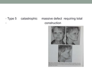 • Type 5 catastrophic massive defect requiring total
• construction
 