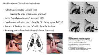 Modifications of the columellar incision
– Rethi transcolumellar incision 1931
(across the apex of the nostril aperture)
– Sercer “nasal decortication” approach 1957
– Goodman modifcation mid columellar ‘V’ facing upwards 1952
– Johnson & Toriumi inverted ‘V’ midcolumellar incision
– Stair-step mid columellar incision (Bahman Guyuron)
 