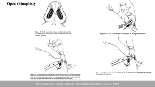 Open rhinoplasty
Dean M Torium, Daniel G Becker; Rhinoplasty dissection manual; 1999
 