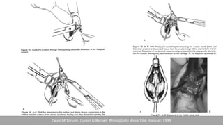 Dean M Torium, Daniel G Becker; Rhinoplasty dissection manual; 1999
 