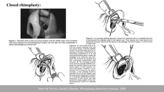 Closed rhinoplasty:
Dean M Torium, Daniel G Becker; Rhinoplasty dissection manual; 1999
 