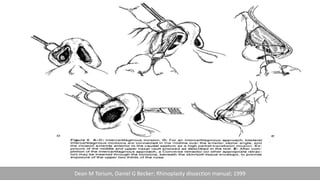 Dean M Torium, Daniel G Becker; Rhinoplasty dissection manual; 1999
 