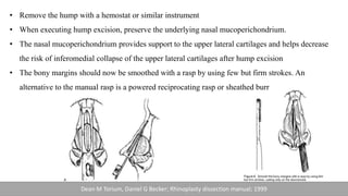 • Remove the hump with a hemostat or similar instrument
• When executing hump excision, preserve the underlying nasal mucoperichondrium.
• The nasal mucoperichondrium provides support to the upper lateral cartilages and helps decrease
the risk of inferomedial collapse of the upper lateral cartilages after hump excision
• The bony margins should now be smoothed with a rasp by using few but firm strokes. An
alternative to the manual rasp is a powered reciprocating rasp or sheathed burr
Dean M Torium, Daniel G Becker; Rhinoplasty dissection manual; 1999
 