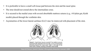 • It is preferable to leave a small soft-tissue pad between the strut and the nasal spine.
• The strut should not extend above the intermediate crura.
• It is secured to the medial crura with several absorbable mattress sutures (e.g., 4-0 plain gut, Keith
needle) placed through the vestibular skin.
• Asymmetries of the lower lateral cartilage (LLC) may be improved with placement of the strut.
Dean M Torium, Daniel G Becker; Rhinoplasty dissection manual; 1999
 