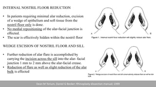 INTERNAL NOSTRIL FLOOR REDUCTION
• In patients requiring minimal alar reduction, excision
of a wedge of epithelium and soft tissue from the
nostril floor only is done.
• No medial repositioning of the alar-facial junction is
effected.
• The scar is effectively hidden within the nostril floor
WEDGE EXCISION OF NOSTRIL FLOOR AND SILL
• Further reduction of alar flare is accomplished by
carrying the incision across the sill into the alar- facial
junction 1 mm to 2 mm above the alar-facial crease.
• Reduction of flare as well as slight reduction of the alar
bulk is effected
Dean M Torium, Daniel G Becker; Rhinoplasty dissection manual; 1999
 