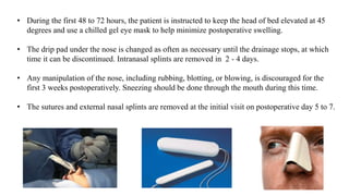 • During the first 48 to 72 hours, the patient is instructed to keep the head of bed elevated at 45
degrees and use a chilled gel eye mask to help minimize postoperative swelling.
• The drip pad under the nose is changed as often as necessary until the drainage stops, at which
time it can be discontinued. Intranasal splints are removed in 2 - 4 days.
• Any manipulation of the nose, including rubbing, blotting, or blowing, is discouraged for the
first 3 weeks postoperatively. Sneezing should be done through the mouth during this time.
• The sutures and external nasal splints are removed at the initial visit on postoperative day 5 to 7.
 