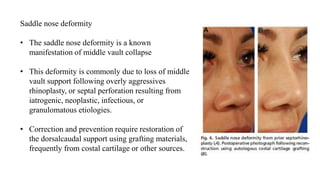 Saddle nose deformity
• The saddle nose deformity is a known
manifestation of middle vault collapse
• This deformity is commonly due to loss of middle
vault support following overly aggressives
rhinoplasty, or septal perforation resulting from
iatrogenic, neoplastic, infectious, or
granulomatous etiologies.
• Correction and prevention require restoration of
the dorsalcaudal support using grafting materials,
frequently from costal cartilage or other sources.
 