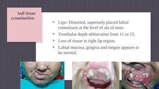 Rhinoplasty oral and maxillofacial surgery | PPTX
