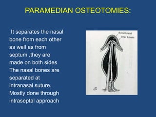 RHINOPLASTY ,Types of incision & Osteotomies.pptx