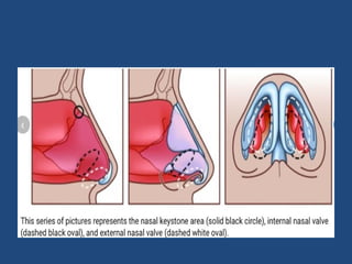 RHINOPLASTY ,Types of incision & Osteotomies.pptx