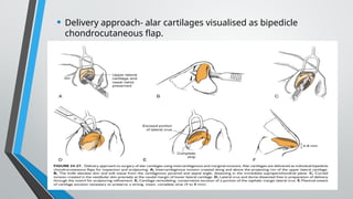 Rhinoplasty pre op preparation and patient selection. | PPTX