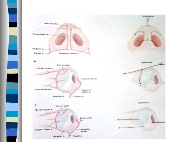 Rhinoplasty approaches ,anatomy,techniques | PPT