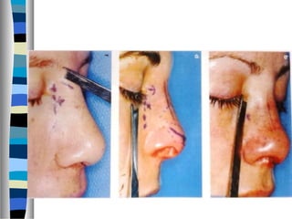 Complete Transfixation Rhinoplasty Rhinoplasty approaches ,anatomy,techniques | PPT