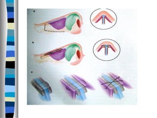 Rhinoplasty approaches ,anatomy,techniques | PPT
