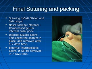 Rhinoplasty2013 | PPT