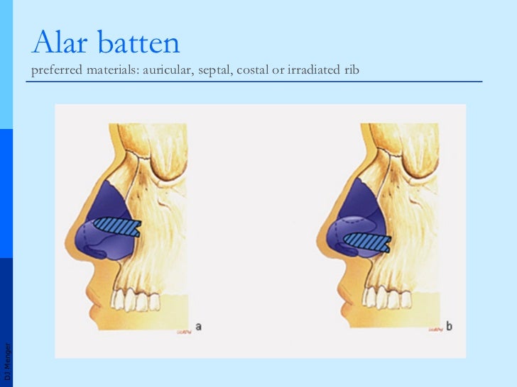 Grafts in Nasal Surgery v1