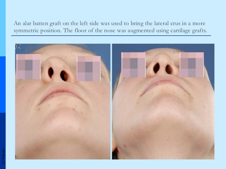 Grafts in Nasal Surgery v1