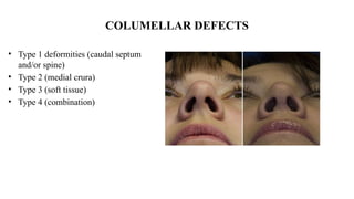 RHINOPLASTY indications and complications | PPTX