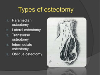 Types of osteotomy
1. Paramedian
osteotomy
2. Lateral osteotomy
3. Transverse
osteotomy
4. Intermediate
osteotomy
5. Oblique osteotomy
 
