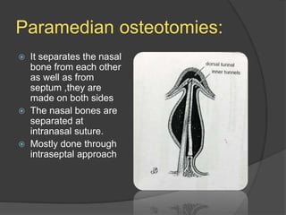Paramedian osteotomies:
 It separates the nasal
bone from each other
as well as from
septum ,they are
made on both sides
 The nasal bones are
separated at
intranasal suture.
 Mostly done through
intraseptal approach
 