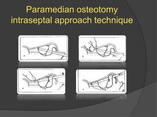 Paramedian osteotomy
intraseptal approach technique
 