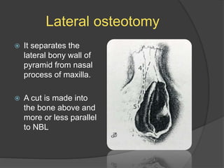 Lateral osteotomy
 It separates the
lateral bony wall of
pyramid from nasal
process of maxilla.
 A cut is made into
the bone above and
more or less parallel
to NBL
 