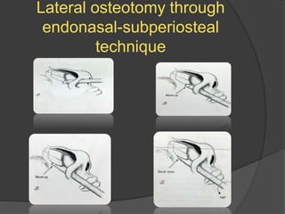 Lateral osteotomy through
endonasal-subperiosteal
technique
 