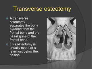 Transverse osteotomy
 A transverse
osteotomy
separates the bony
pyramid from the
frontal bone and the
nasal spine of the
frontal bone.
 This osteotomy is
usually made at a
level just below the
nasion
 