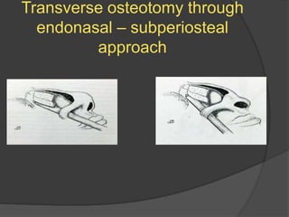 Transverse osteotomy through
endonasal – subperiosteal
approach
 