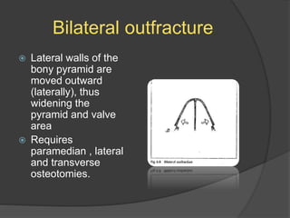 Bilateral outfracture
 Lateral walls of the
bony pyramid are
moved outward
(laterally), thus
widening the
pyramid and valve
area
 Requires
paramedian , lateral
and transverse
osteotomies.
 