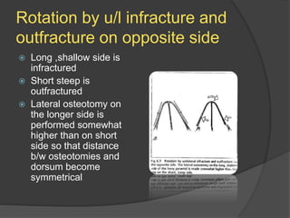 Rotation by u/l infracture and
outfracture on opposite side
 Long ,shallow side is
infractured
 Short steep is
outfractured
 Lateral osteotomy on
the longer side is
performed somewhat
higher than on short
side so that distance
b/w osteotomies and
dorsum become
symmetrical
 