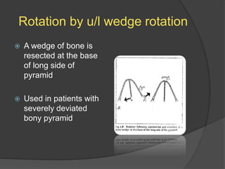 Rotation by u/l wedge rotation
 A wedge of bone is
resected at the base
of long side of
pyramid
 Used in patients with
severely deviated
bony pyramid
 
