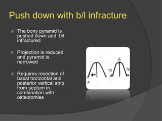 Push down with b/l infracture
 The bony pyramid is
pushed down and b/l
infractured
 Projection is reduced
and pyramid is
narrowed
 Requires resection of
basal horizontal and
posterior vertical strip
from septum in
combination with
osteotomies
 