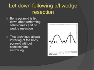 Let down following b/l wedge
resection
 Bony pyramid is let
down after performing
osteotomies and b/l
wedge resection
 This technique allows
lowering of the bony
pyramid without
concominant
narrowing.
 