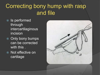 Correcting bony hump with rasp
and file
 Is performed
through
intercartilaginous
incision
 Only bony bumps
can be corrected
with this .
 Not effective on
cartilage
 
