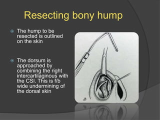 Resecting bony hump
 The hump to be
resected is outlined
on the skin
 The dorsum is
approached by
combining the right
intercartilaginous with
the CSI. This is f/b
wide undermining of
the dorsal skin
 