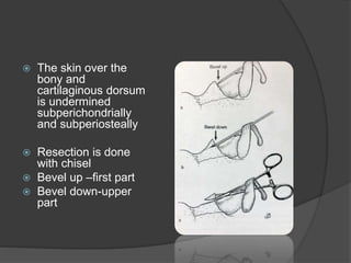  The skin over the
bony and
cartilaginous dorsum
is undermined
subperichondrially
and subperiosteally
 Resection is done
with chisel
 Bevel up –first part
 Bevel down-upper
part
 