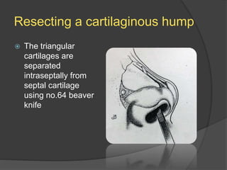 Resecting a cartilaginous hump
 The triangular
cartilages are
separated
intraseptally from
septal cartilage
using no.64 beaver
knife
 